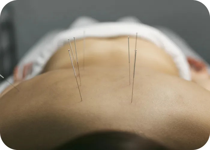 طب سوزنی 3 Treatment method in acupuncture